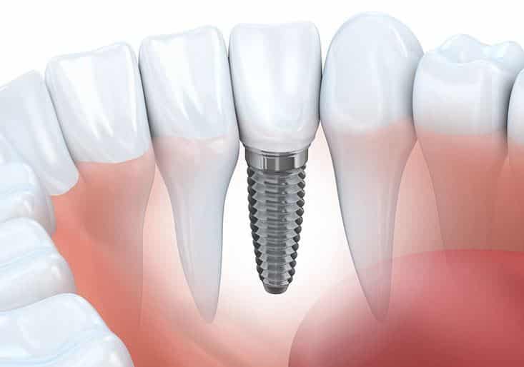 Dental Implant Structure Diagram