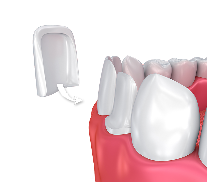 Dental Veneer Anatomy Diagram