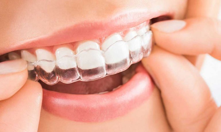 Invisalign Bright Smile Dental P C