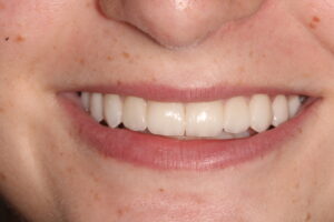 Radiant No-Prep Veneers Makeover: Stunning smile transition with no-prep veneers.