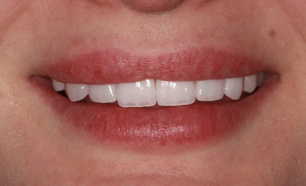 Flawless No-Prep Veneers Result: Stunning smile enhanced with no-prep veneers.