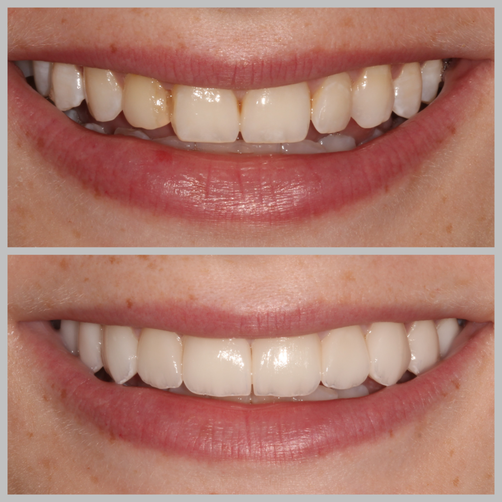 No Prep Veneers: before and after