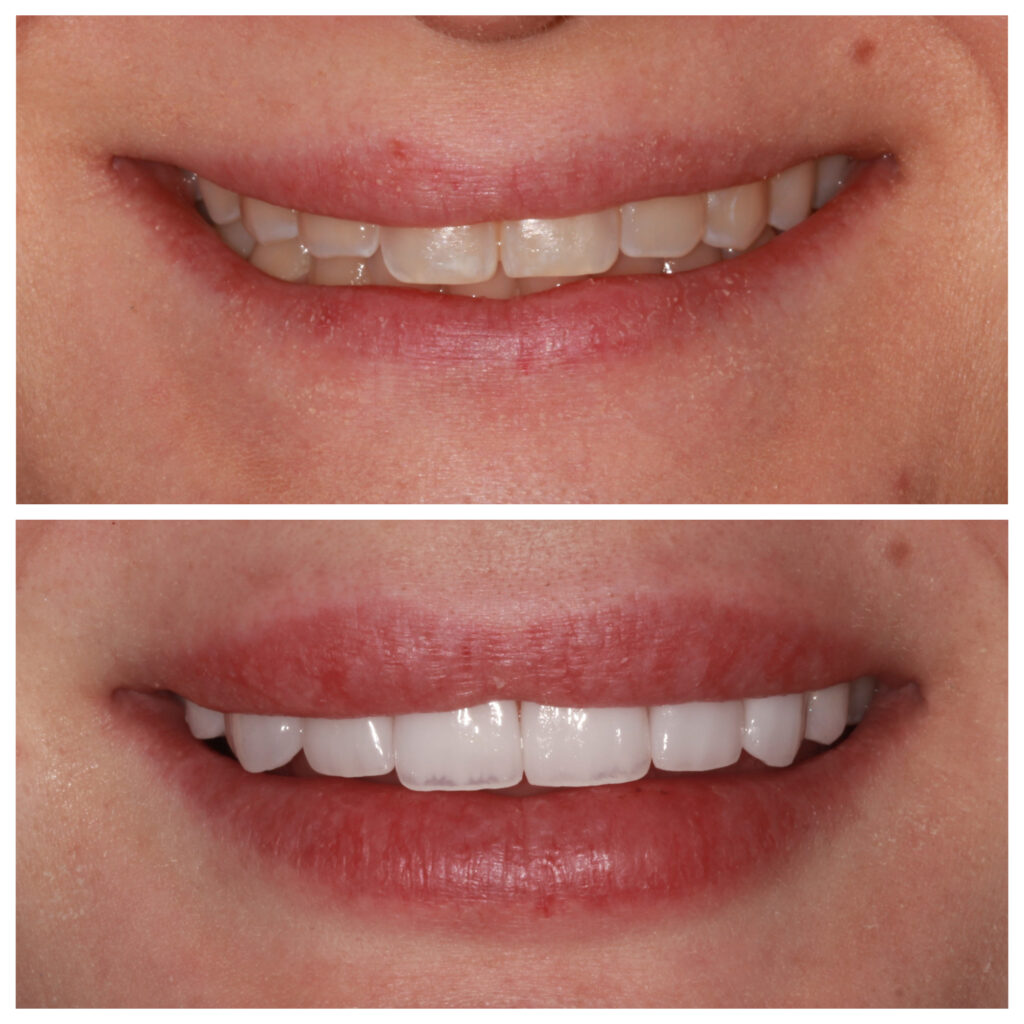 No Prep Veneers: before and after