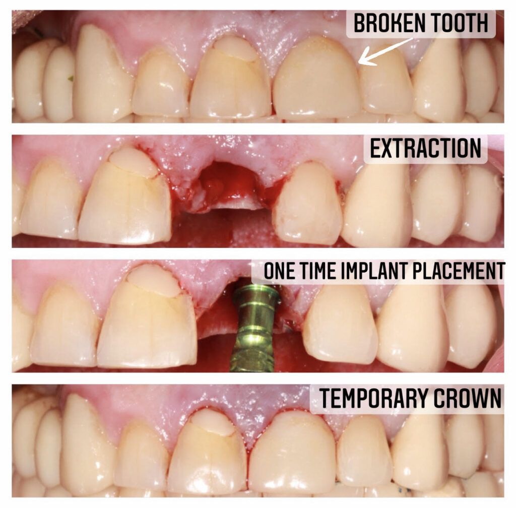 Before, During, and After Immediate Placement and Immediate Loading of Upper Anterior Implant