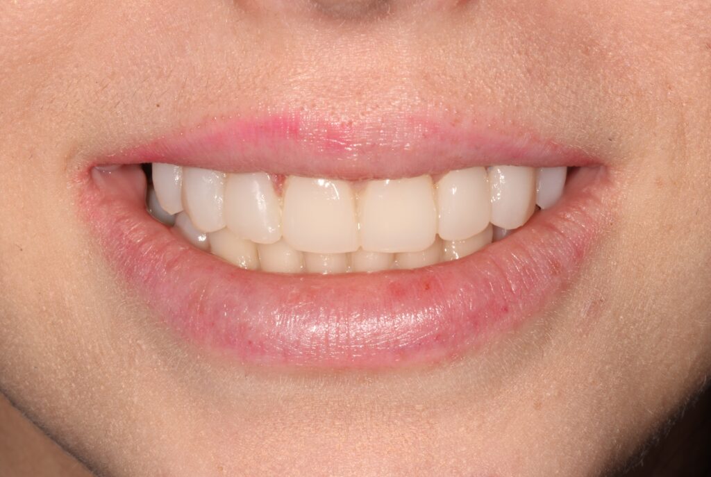 Temporary Veneers: Transitional veneers in place, preserving smile aesthetics during custom veneer crafting.