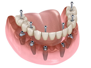 All-on-X Dental Restoration Illustration