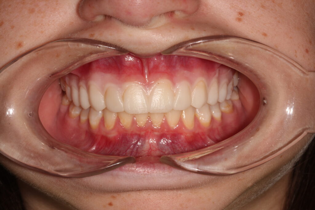 Smile Verification: Temporary Veneers from Wax Up for a natural-looking veneers