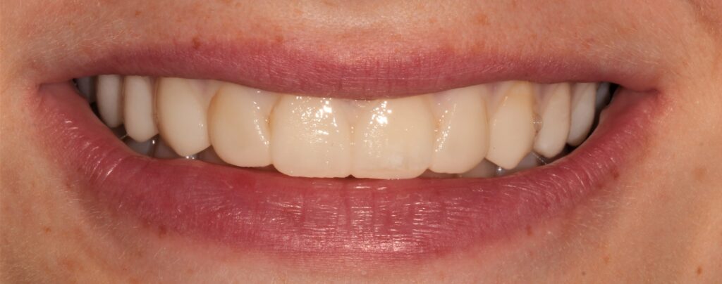 Smile Verification: Temporary Veneers from Wax Up