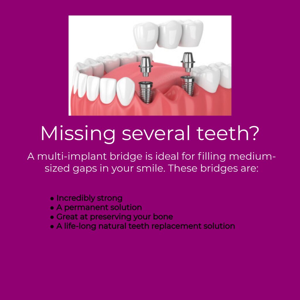 3-Unit Implant Bridge Illustration