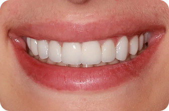 Ten No-Prep Dental Veneers for a Stunning Smile