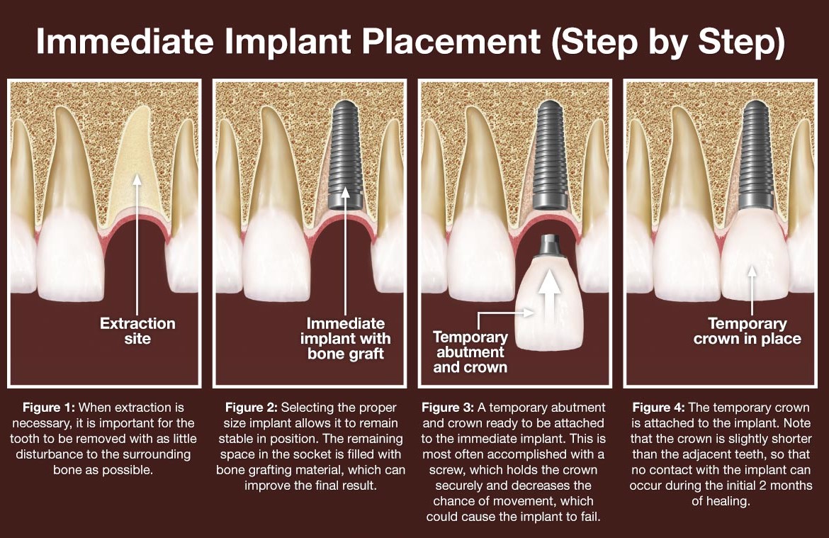 The Dental Implant Procedure: A Step-by-Step Guide - Bright Smile ...