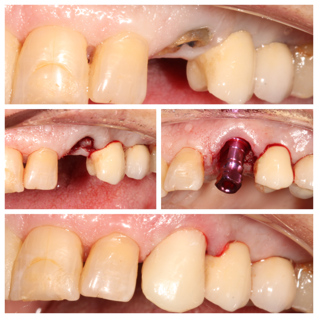 Collage showing the step-by-step process of immediate upper canine implant placement and loading as one of the best tooth replacement options
