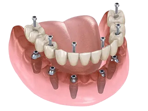 ALL On-X Dental Implants