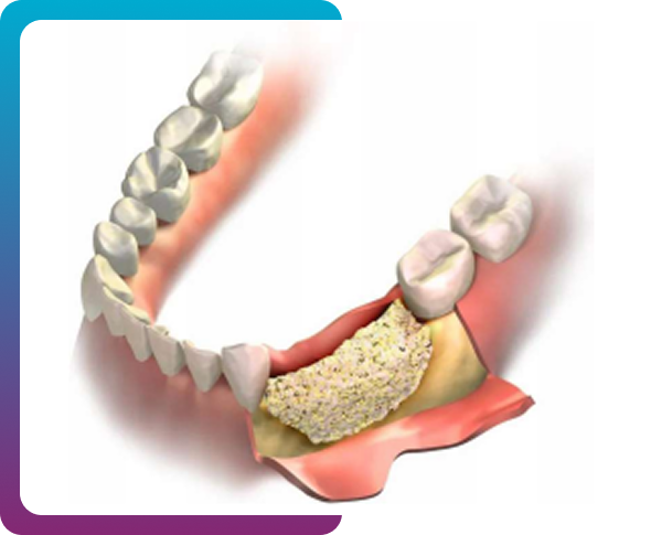 Bone Graft
