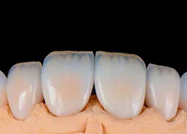 Bright Smile Veneers Difference