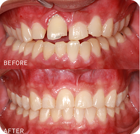 Invisalign Treatment