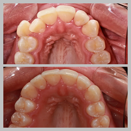 Invisalign Pictures