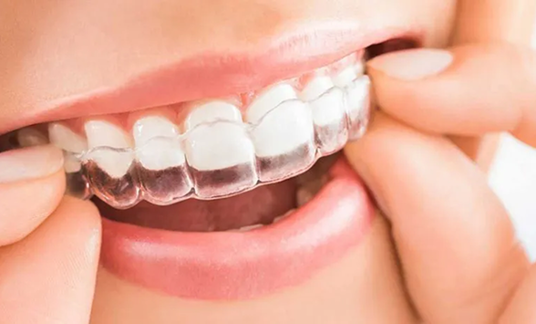 Invisalign
