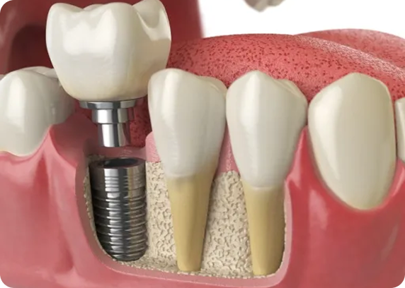 Illustration of a Dental Implant