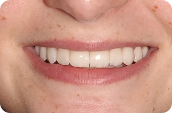 beautiful-and-functional-smile