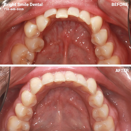 Invisalign Pictures 2