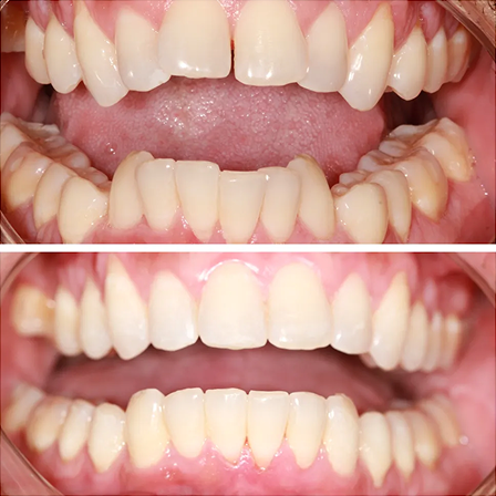 Invisalign Pictures 3