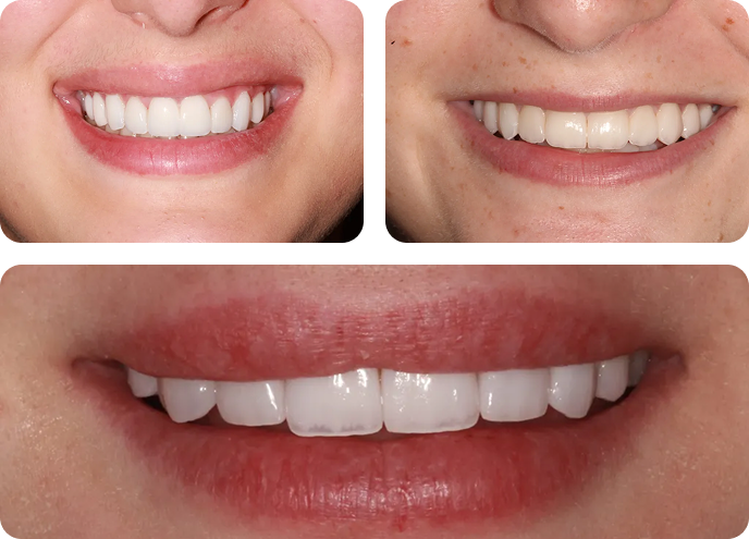 No prep dental veneers img