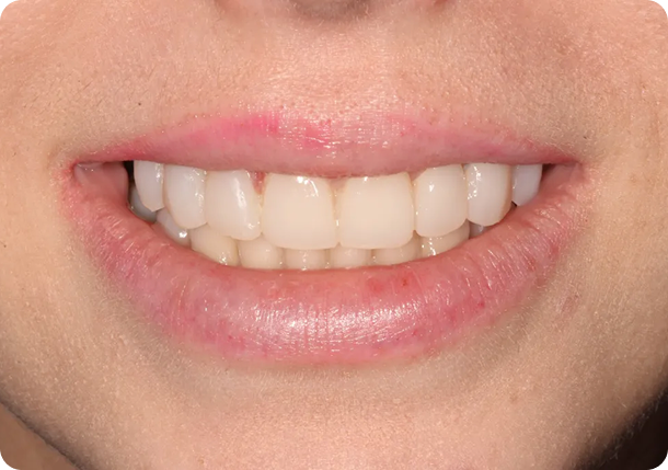 Process preparation and temporary dental veneers