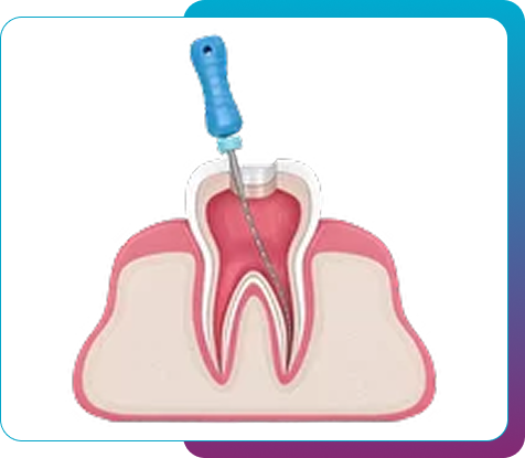 Root Canals