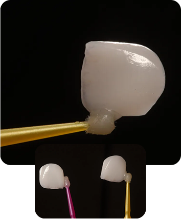 What are dental veneers? mobile img