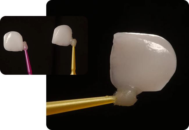 What are dental veneers?