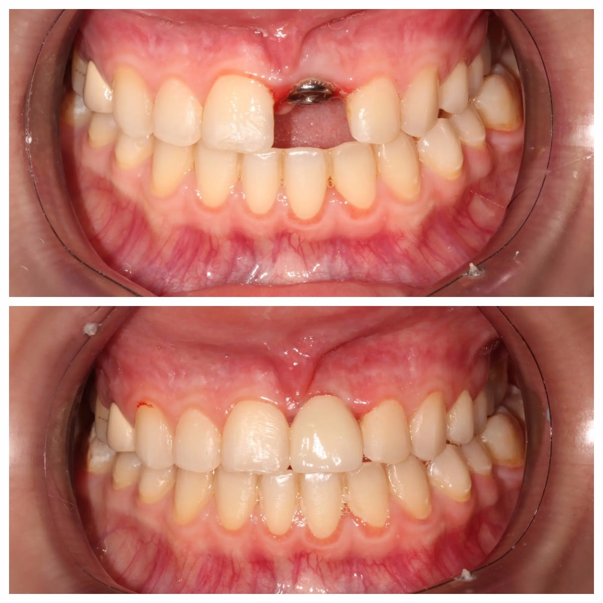 Before and after smile transformation, Bright Smile Dental Brooklyn.