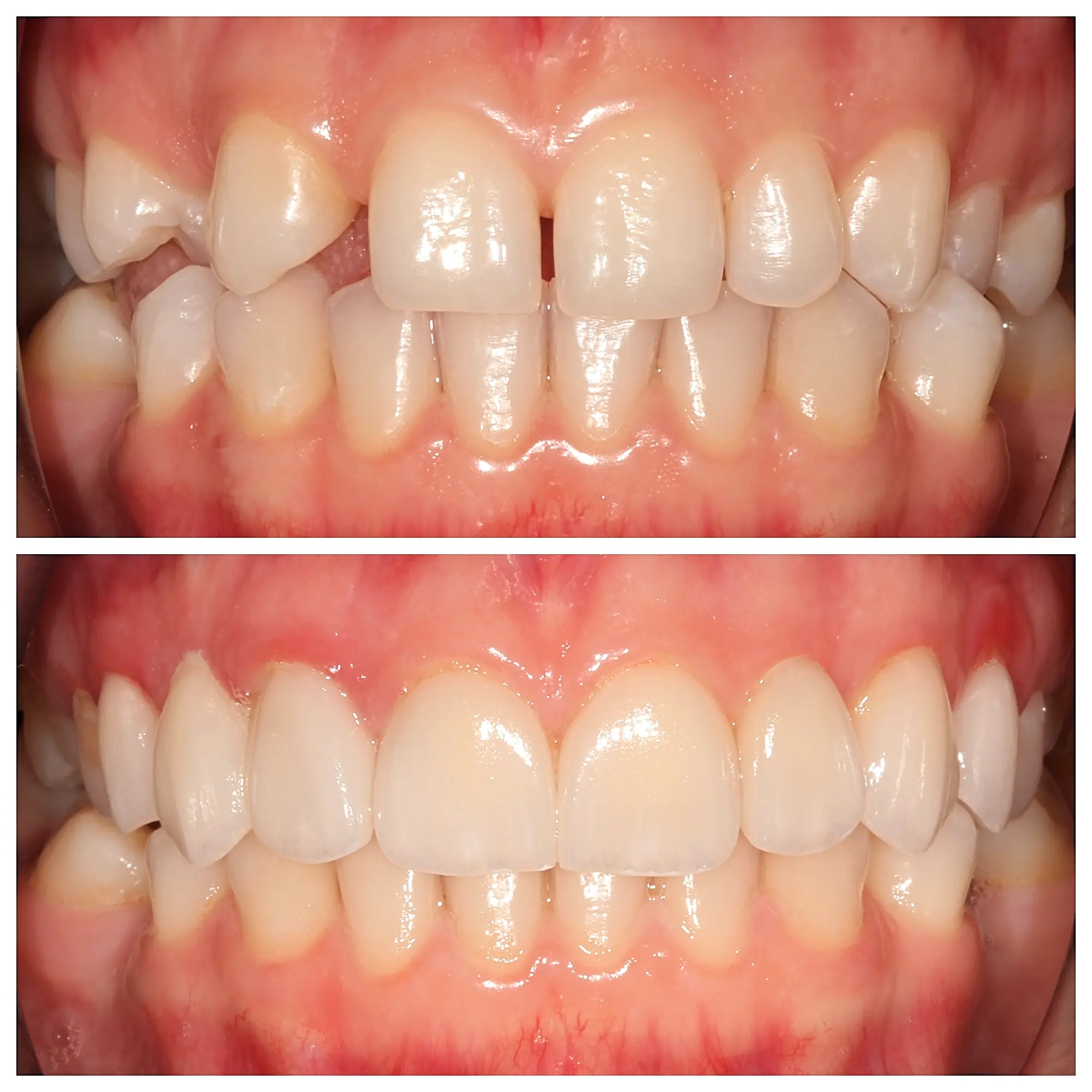 Before and after smile transformation, Bright Smile Dental Brooklyn.