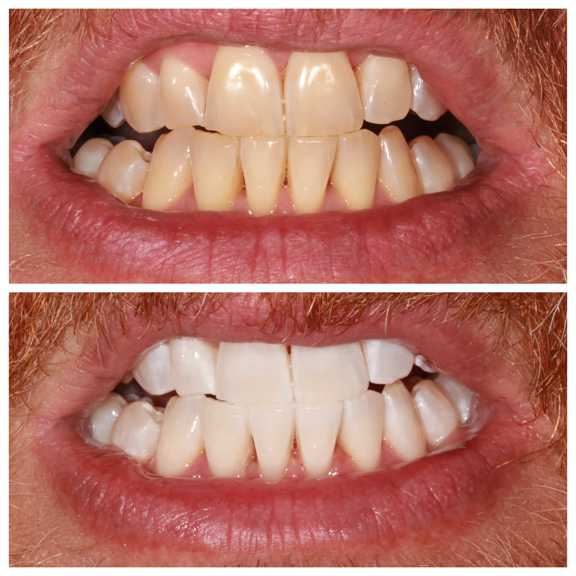 Before and after smile transformation, Bright Smile Dental Brooklyn.