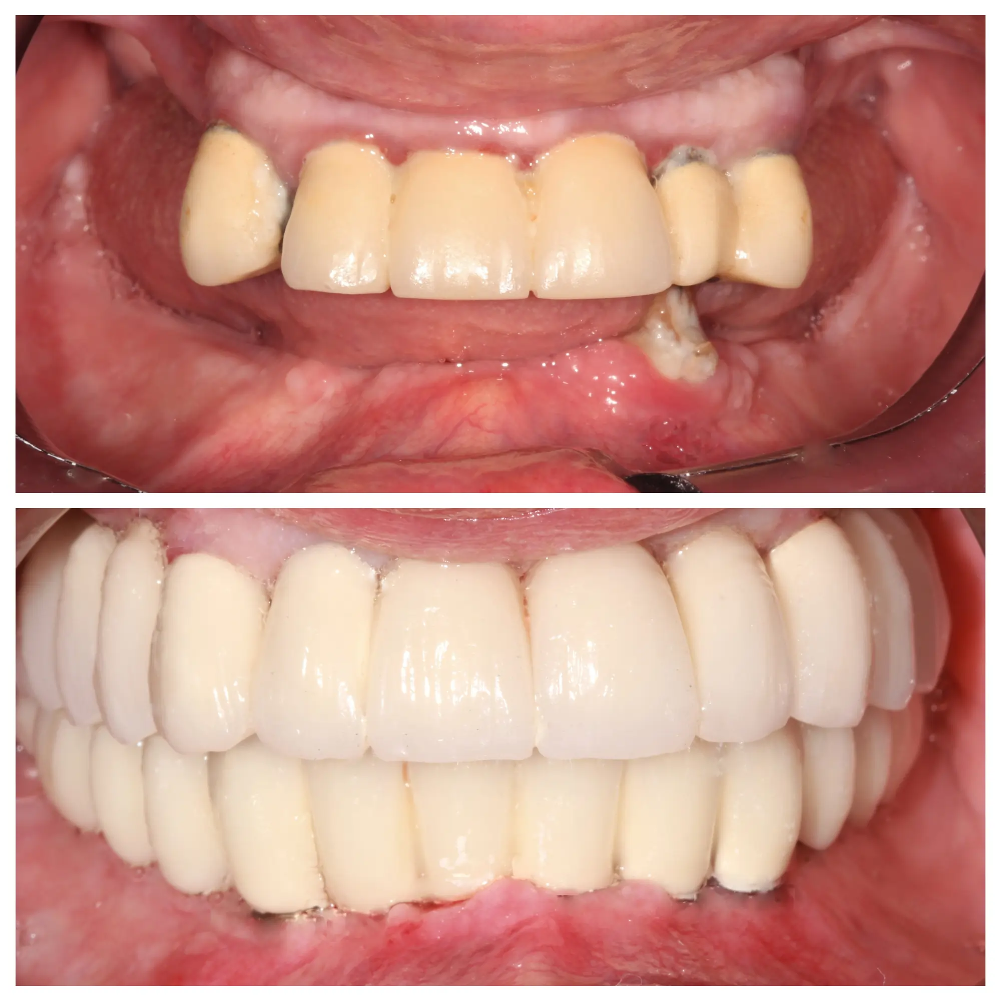Before and after smile transformation, Bright Smile Dental Brooklyn.