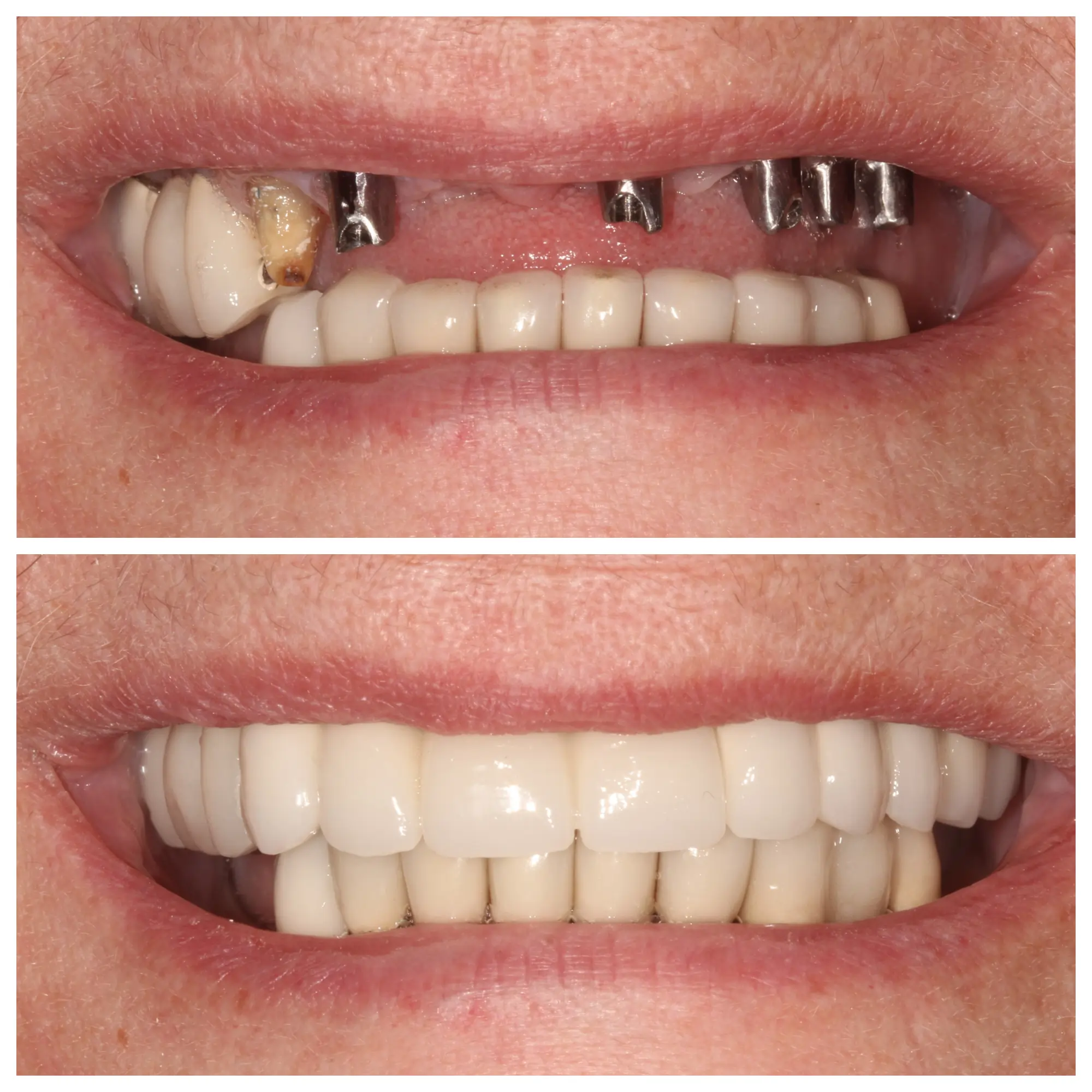 Before and after smile transformation, Bright Smile Dental Brooklyn.