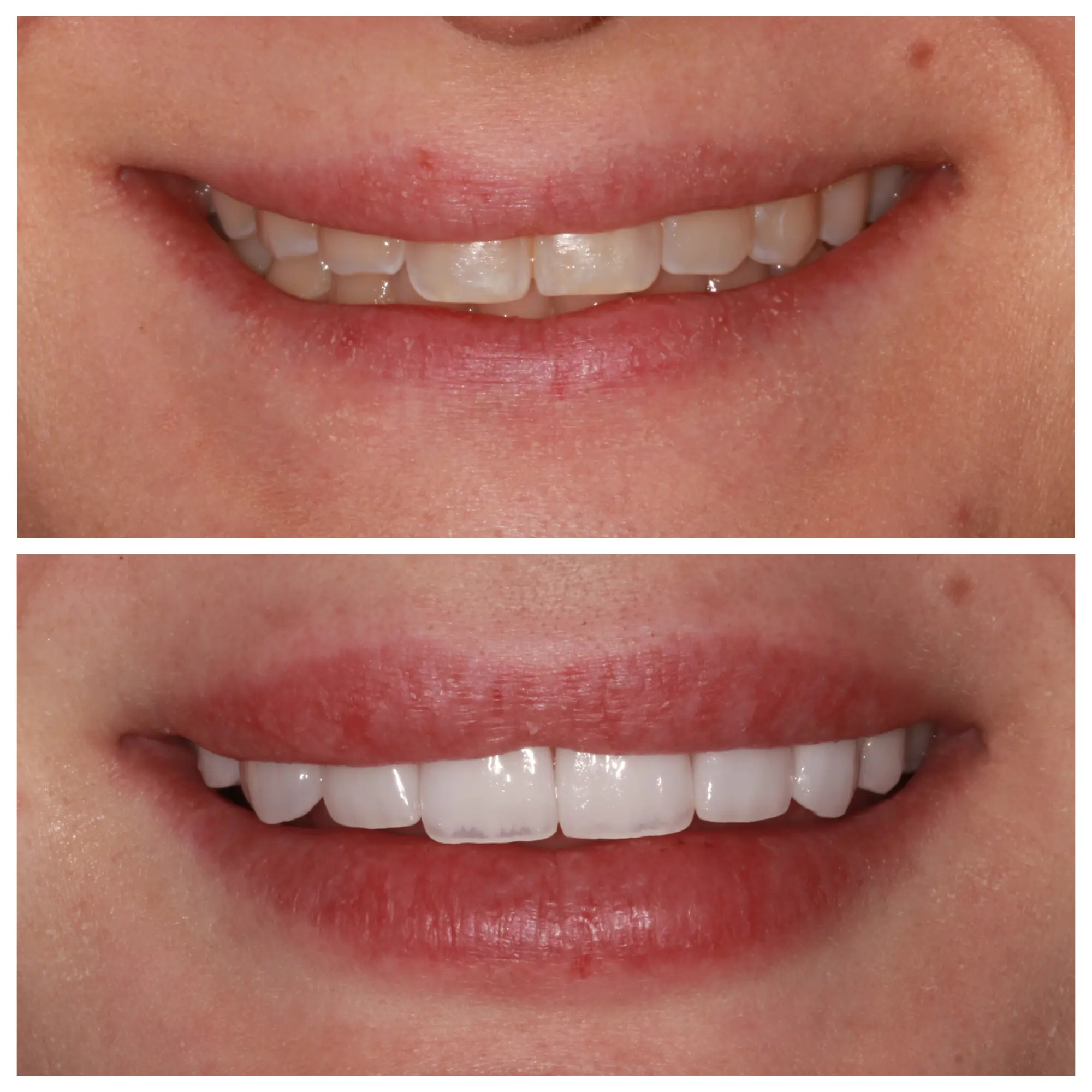 Before and after smile transformation, Bright Smile Dental Brooklyn.