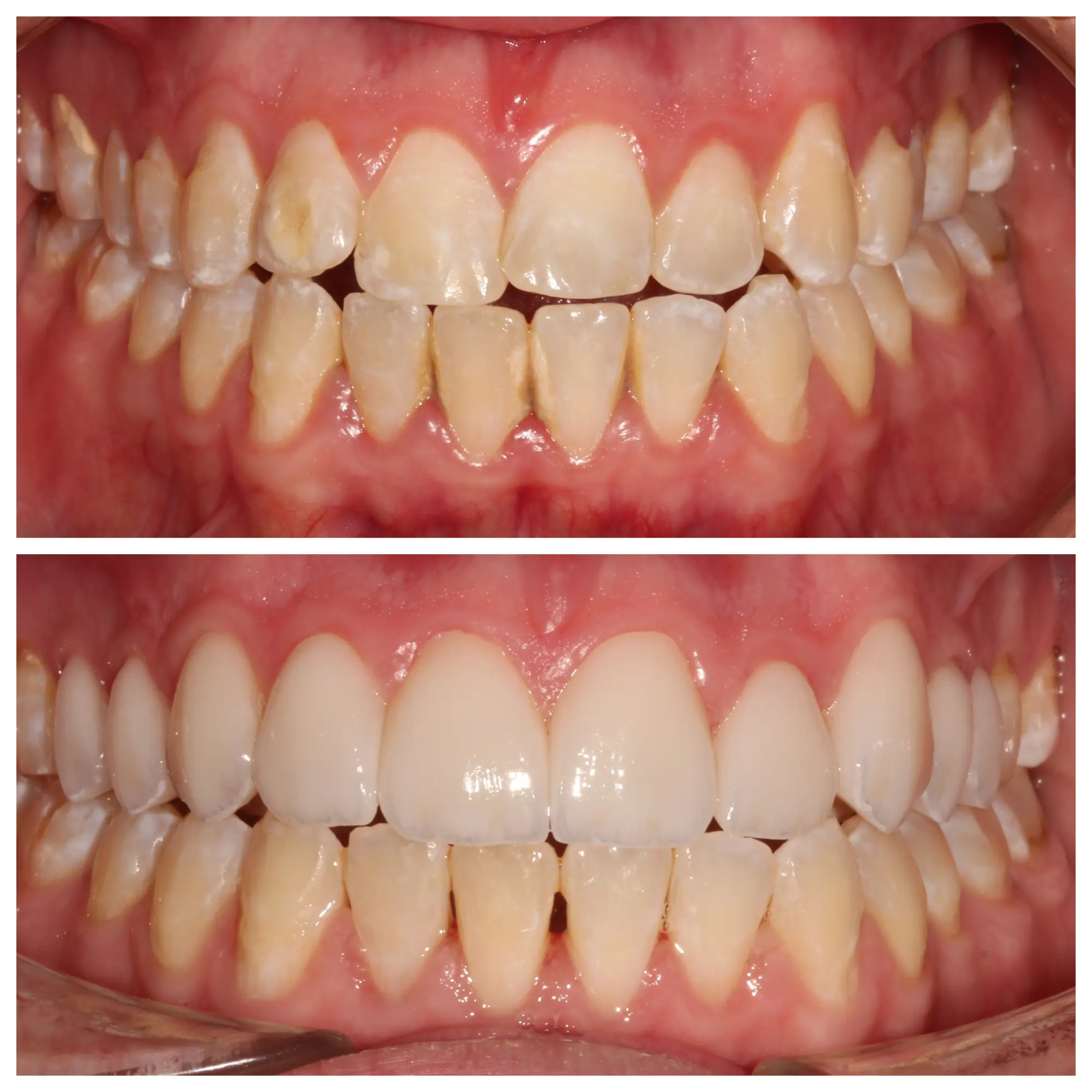 Before and after smile transformation, Bright Smile Dental Brooklyn.