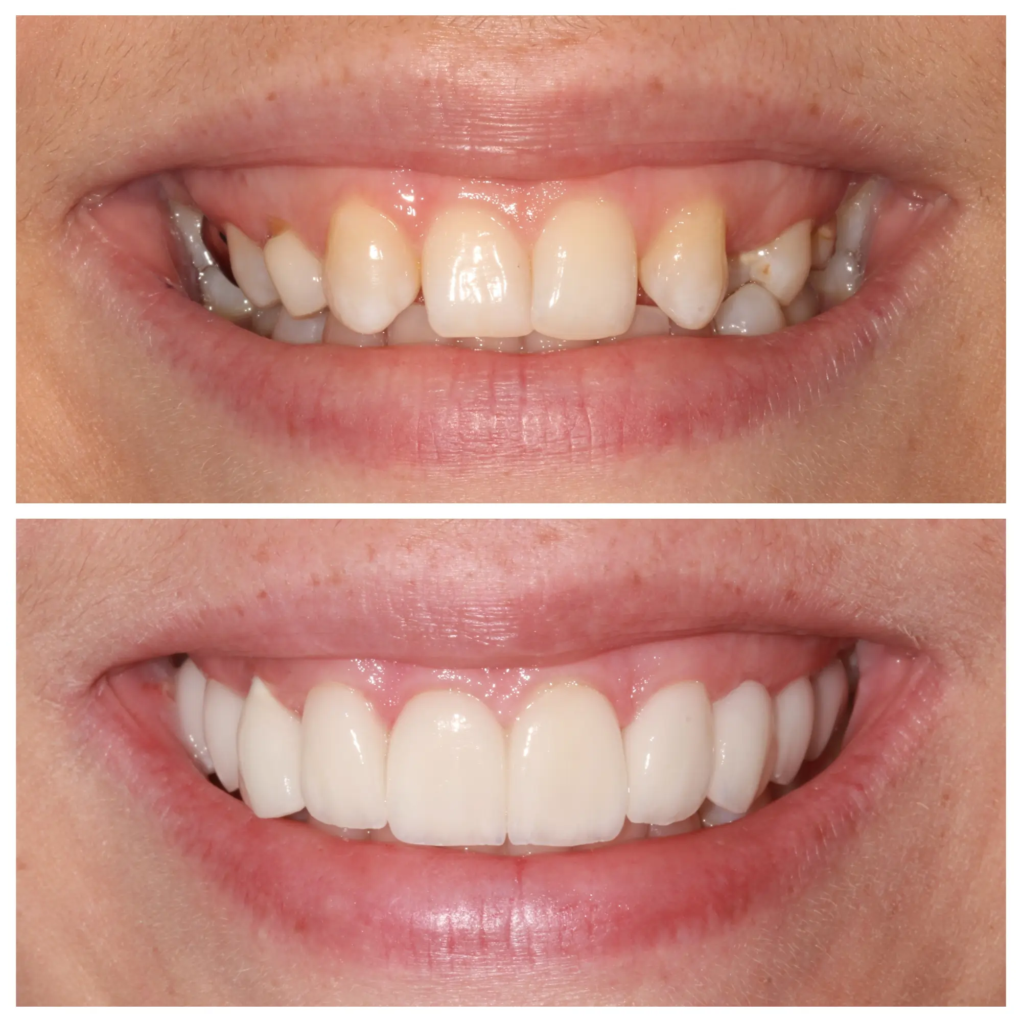Before and after smile transformation, Bright Smile Dental Brooklyn.