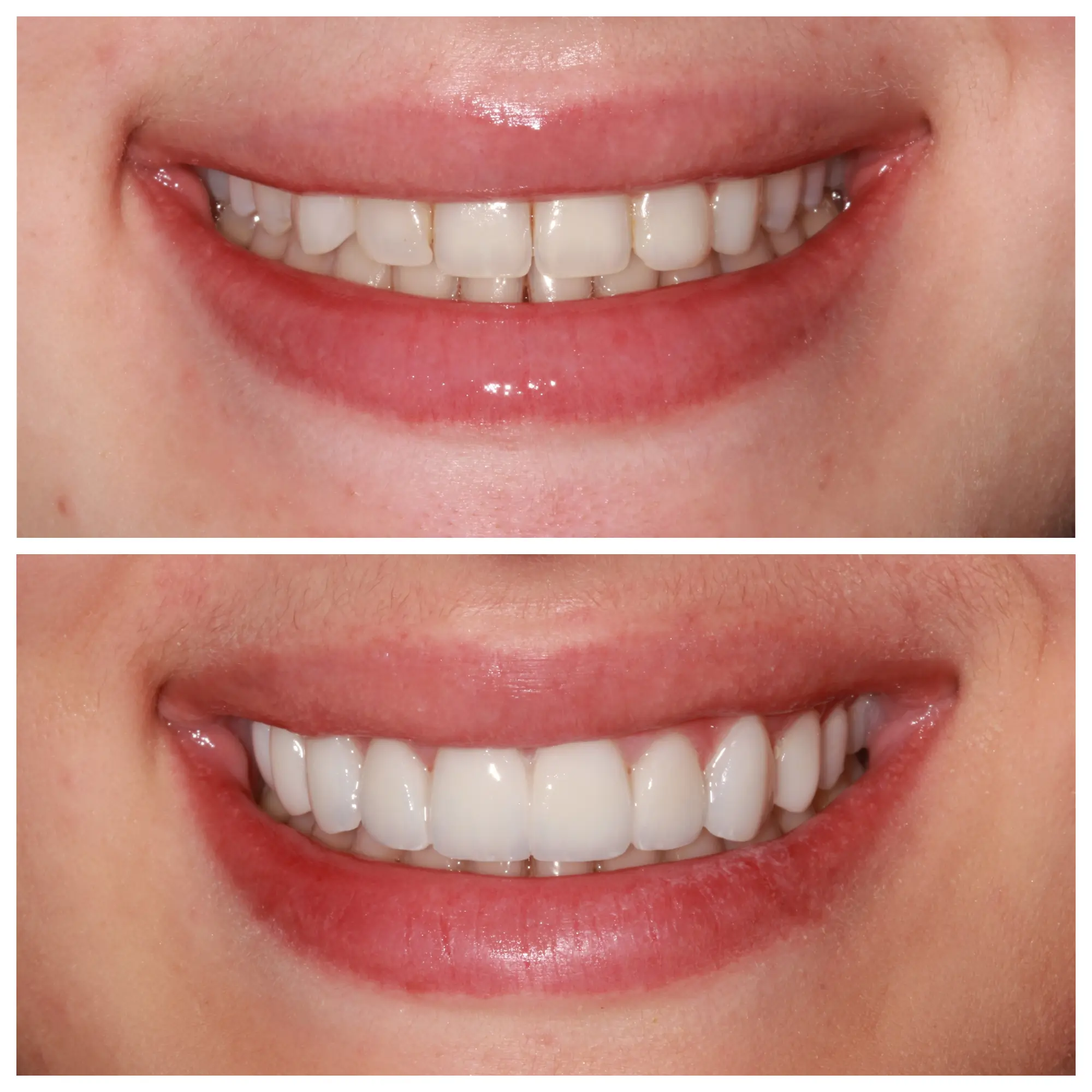 Before and after smile transformation, Bright Smile Dental Brooklyn.